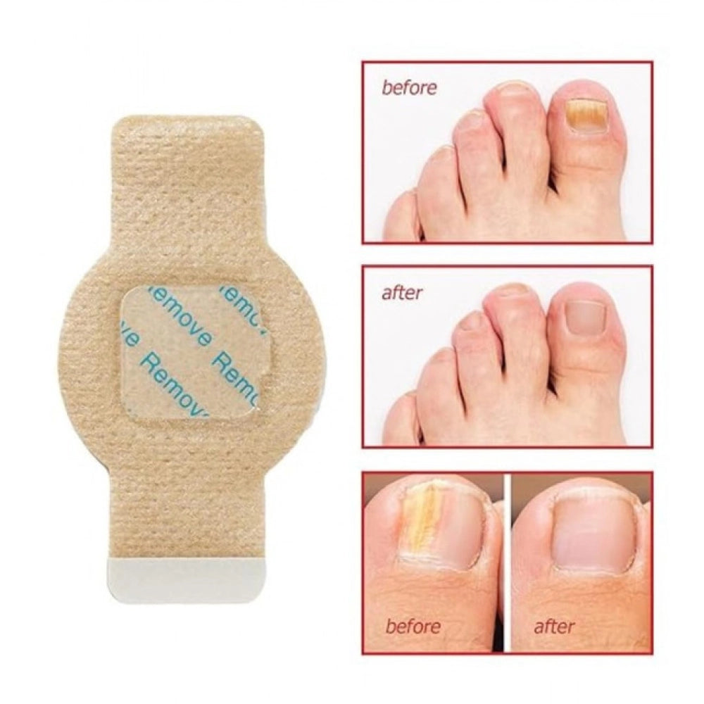 Fungal Nail Patches — Yellow