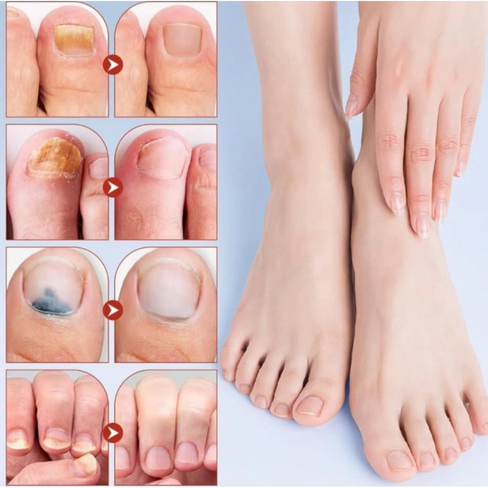 Fungal Nail Patches — Yellow